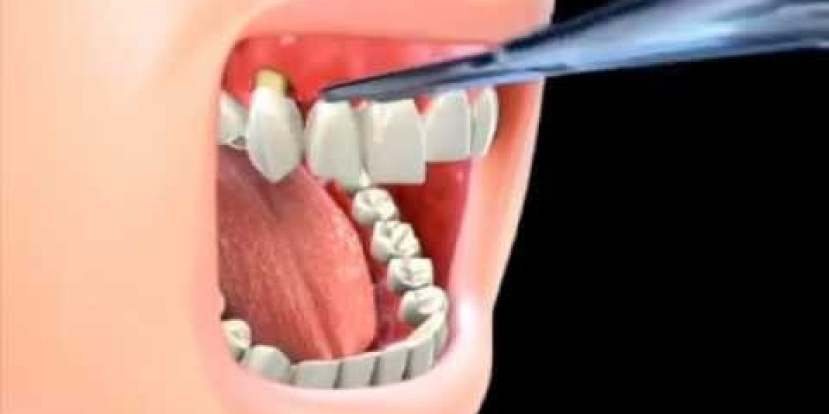 Dental Crown Bridges in Islamabad – A Complete Solution for Restoring Your Smile
