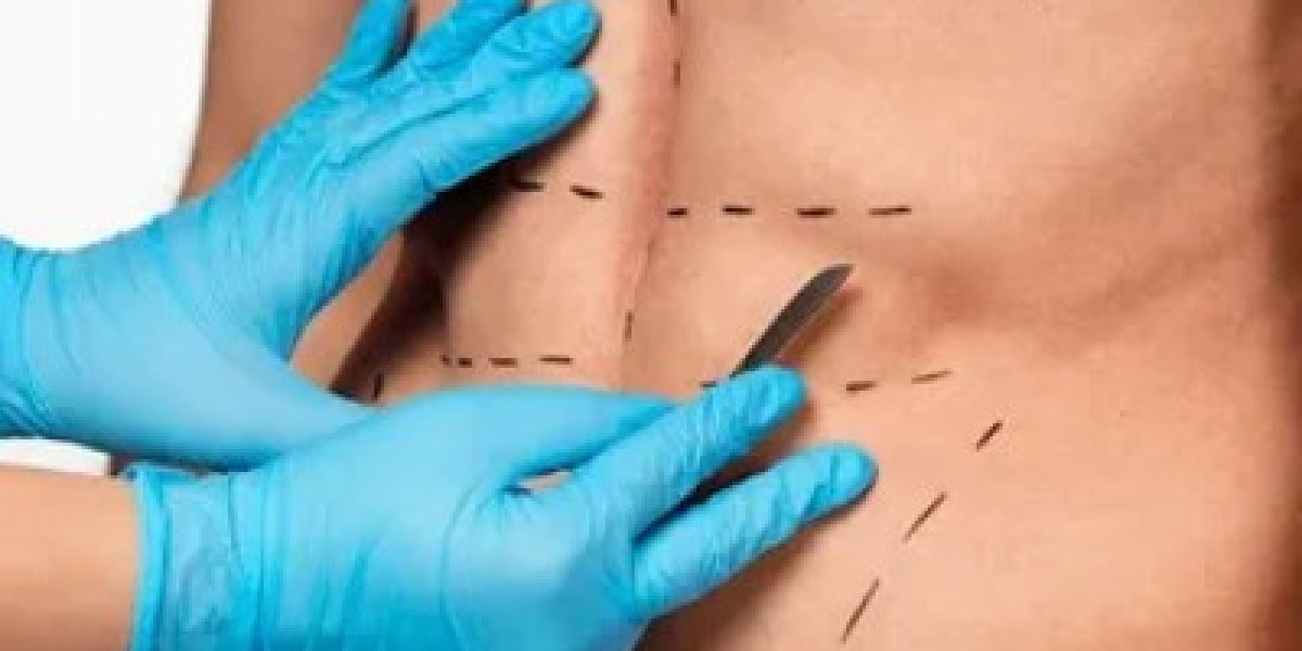 Liposuction in Islamabad – An Effective Procedure for Enhancing Body Proportions