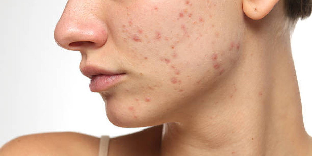 What to Expect During an Acne Scar Treatment Consultation
